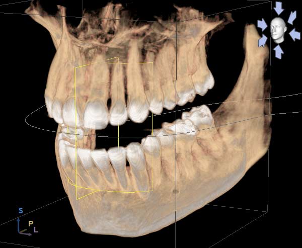 3d cat scan of a jaw