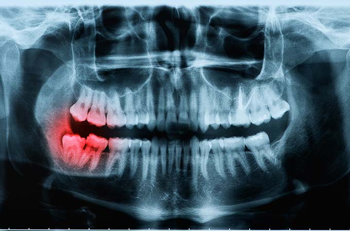 x ray of problem teeth