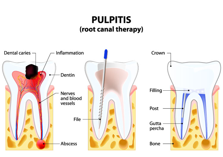 a graph on how root canels are preformed